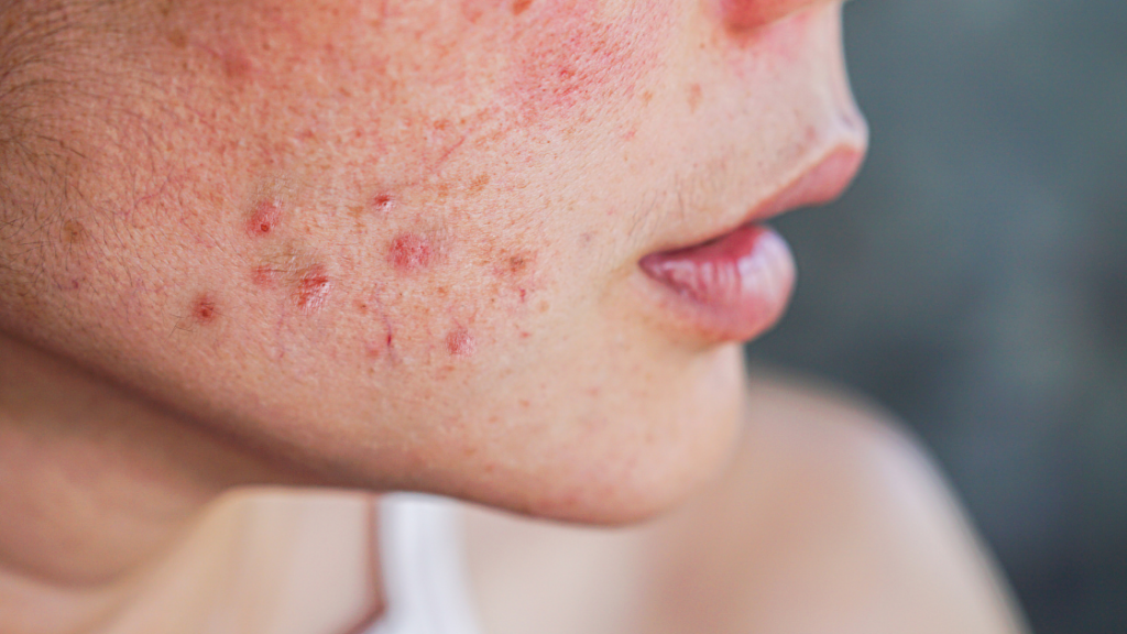 How to get rid of acne. Uncover Simple & Natural Methods.