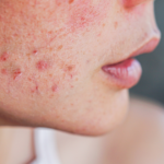 How to get rid of acne. Uncover Simple & Natural Methods.